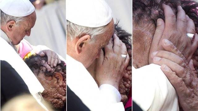 Pope Francis Kisses Man Plagued With Boils